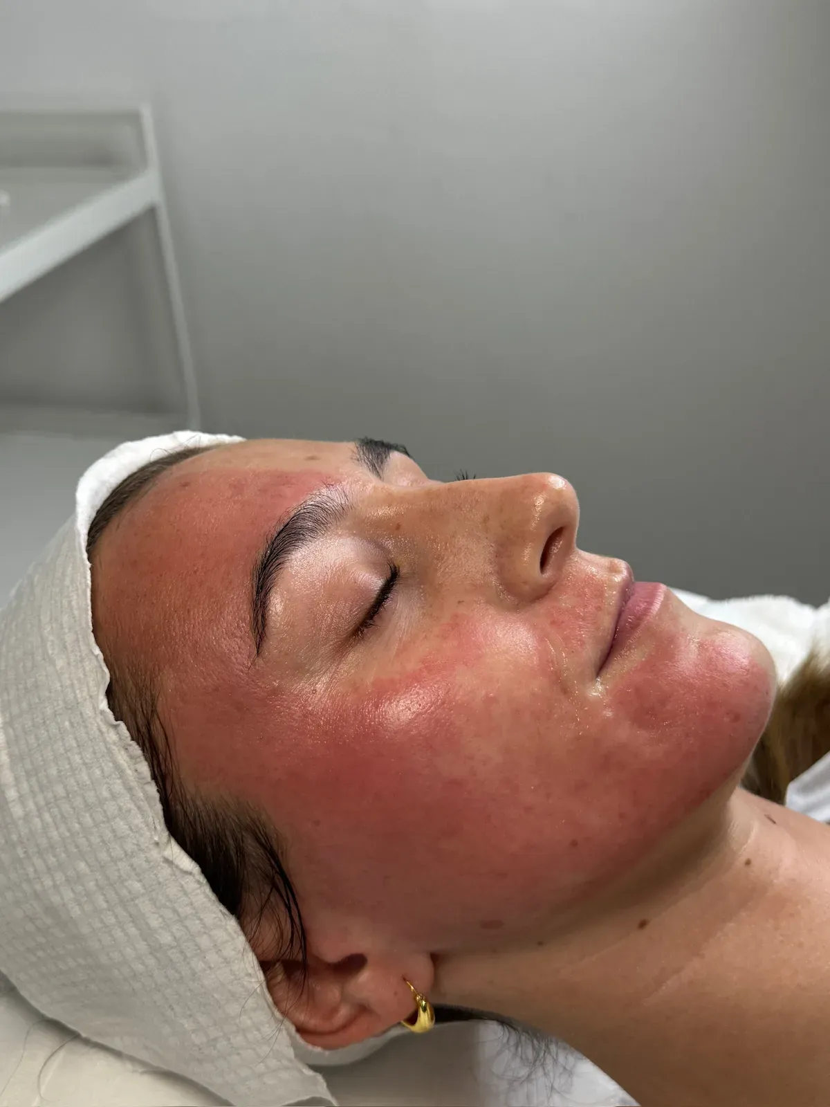A client's skin immediately after SkinPen, red as expected
