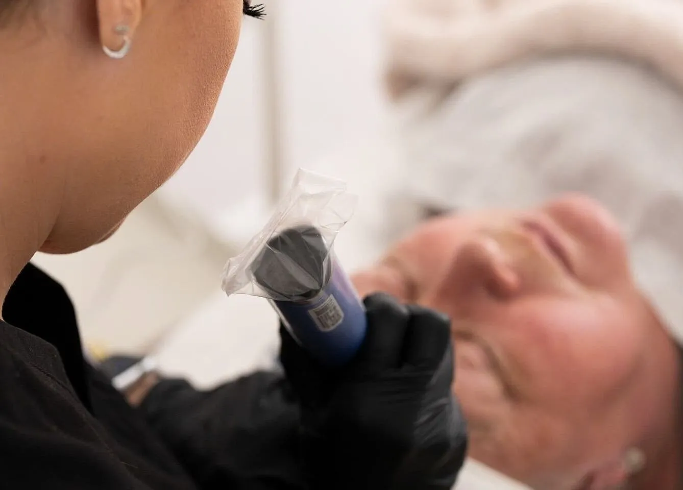 SkinPen treatment at Pearl